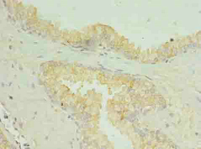 SLC34A2 / NaPi-2b Antibody - Immunohistochemistry of paraffin-embedded human prostate cancer at dilution of 1:100