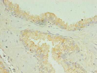 SLC34A2 / NaPi-2b Antibody - Immunohistochemistry of paraffin-embedded human prostate cancer using SLC34A2 Antibody at dilution of 1:100