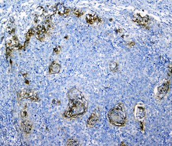 SLC34A2 / NaPi-2b Antibody - IHC staining of FFPE human lung cancer with SLC34A2 antibody. HIER: boil tissue sections in pH6, 10mM citrate buffer, for 10-20 min and allow to cool before testing.