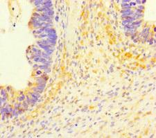 SLC35D2 Antibody - Immunohistochemistry of paraffin-embedded human ovarian cancer using SLC35D2 Antibody at dilution of 1:100
