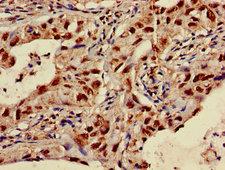 SLC35F2 Antibody - Immunohistochemistry of paraffin-embedded human lung cancer using SLC35F2 Antibody at dilution of 1:100