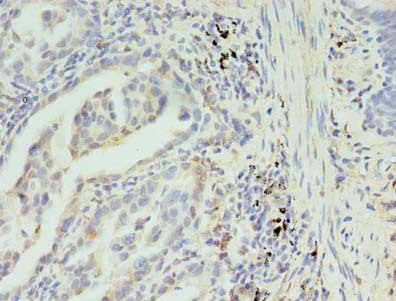 SLC35F5 Antibody - Immunohistochemistry of paraffin-embedded human lung cancer using antibody at dilution of 1:100.