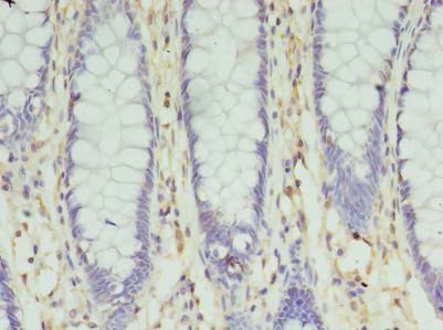 SLC35F5 Antibody - Immunohistochemistry of paraffin-embedded human colon cancer using antibody at dilution of 1:100.