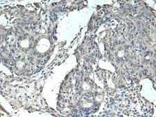 SLC35F6 Antibody - Immunohistochemistry of paraffin-embedded Human colorectal cancer tissue  using SLC35F6 Polyclonal Antibody at dilution of 1:95(×200)