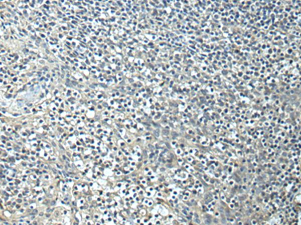 SLC35F6 Antibody - Immunohistochemistry of paraffin-embedded Human tonsil tissue  using SLC35F6 Polyclonal Antibody at dilution of 1:95(×200)