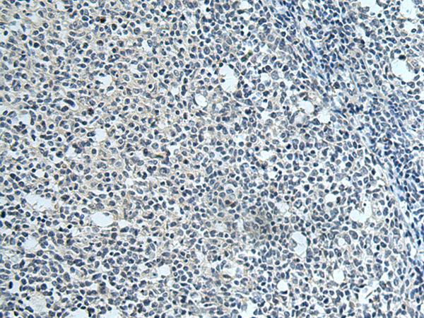 SLC35F6 Antibody - Immunohistochemistry of paraffin-embedded Human tonsil tissue  using SLC35F6 Polyclonal Antibody at dilution of 1:115(×200)