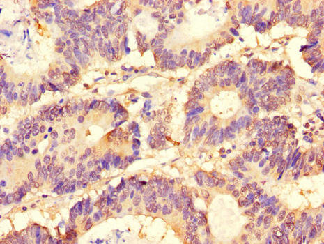 SLC37A1 Antibody - Immunohistochemistry of paraffin-embedded human colon cancer tissue using SLC37A1 Antibody at dilution of 1:100