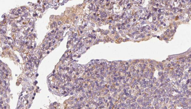 SLC38A3 / SNAT3 Antibody - 1:100 staining human lymph carcinoma tissue by IHC-P. The sample was formaldehyde fixed and a heat mediated antigen retrieval step in citrate buffer was performed. The sample was then blocked and incubated with the antibody for 1.5 hours at 22°C. An HRP conjugated goat anti-rabbit antibody was used as the secondary.
