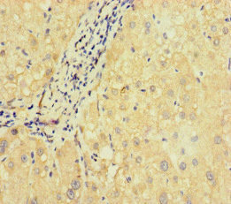 SLC38A9 Antibody - Immunohistochemistry of paraffin-embedded human liver cancer at dilution of 1:100