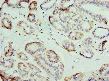 SLC39A6 / LIV-1 Antibody - Immunohistochemistry of paraffin-embedded human breast cancer using antibody at 1:100 dilution.