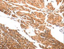 SLC39A6 / LIV-1 Antibody - Immunohistochemistry of paraffin-embedded Human cervical cancer using SLC39A6 Polyclonal Antibody at dilution of 1:30.