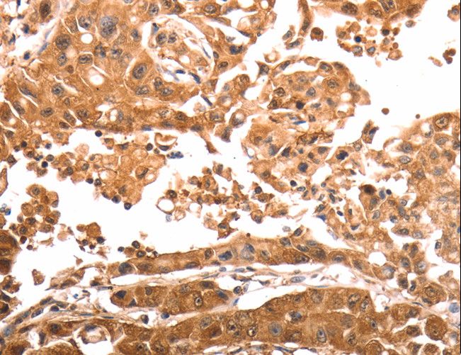 SLC39A6 / LIV-1 Antibody - Immunohistochemistry of paraffin-embedded Human lung cancer using SLC39A6 Polyclonal Antibody at dilution of 1:30.
