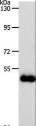 SLC39A6 / LIV-1 Antibody - Western blot analysis of Human colon cancer tissue, using SLC39A6 Polyclonal Antibody at dilution of 1:500.