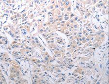SLC39A6 / LIV-1 Antibody - Immunohistochemistry of paraffin-embedded Human lung cancer using SLC39A6 Polyclonal Antibody at dilution of 1:30.