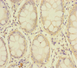 SLC39A7 / ZIP7 Antibody - Immunohistochemistry of paraffin-embedded human colon cancer at dilution of 1:100