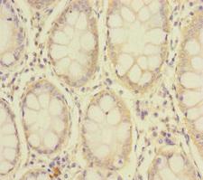 SLC39A7 / ZIP7 Antibody - Immunohistochemistry of paraffin-embedded human colon cancer at dilution of 1:100