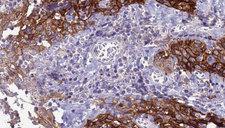 SLC39A8 / ZIP8 Antibody - 1:100 staining human Head and neck carcinoma tissue by IHC-P. The sample was formaldehyde fixed and a heat mediated antigen retrieval step in citrate buffer was performed. The sample was then blocked and incubated with the antibody for 1.5 hours at 22°C. An HRP conjugated goat anti-rabbit antibody was used as the secondary.