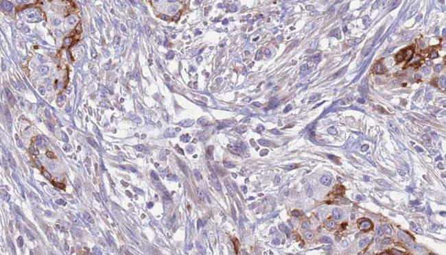 SLC3A1 / ATR1 Antibody - 1:100 staining human urothelial carcinoma tissue by IHC-P. The sample was formaldehyde fixed and a heat mediated antigen retrieval step in citrate buffer was performed. The sample was then blocked and incubated with the antibody for 1.5 hours at 22°C. An HRP conjugated goat anti-rabbit antibody was used as the secondary.