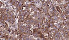 SLC3A2 / CD98 Heavy Chain Antibody - 1:100 staining human liver carcinoma tissues by IHC-P. The sample was formaldehyde fixed and a heat mediated antigen retrieval step in citrate buffer was performed. The sample was then blocked and incubated with the antibody for 1.5 hours at 22°C. An HRP conjugated goat anti-rabbit antibody was used as the secondary.
