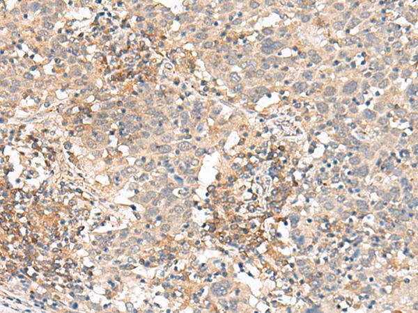 SLC40A1 / Ferroportin-1 Antibody - Immunohistochemistry of paraffin-embedded Human cervical cancer tissue  using SLC40A1 Polyclonal Antibody at dilution of 1:90(×200)