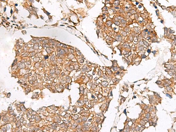 SLC40A1 / Ferroportin-1 Antibody - Immunohistochemistry of paraffin-embedded Human lung cancer tissue  using SLC40A1 Polyclonal Antibody at dilution of 1:65(×200)