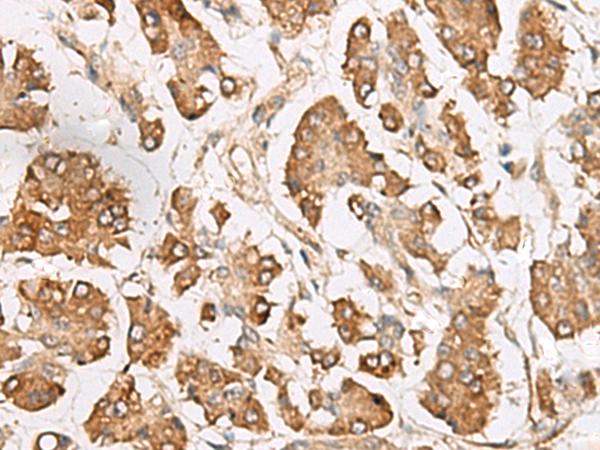 SLC40A1 / Ferroportin-1 Antibody - Immunohistochemistry of paraffin-embedded Human gastric cancer tissue  using SLC40A1 Polyclonal Antibody at dilution of 1:65(×200)
