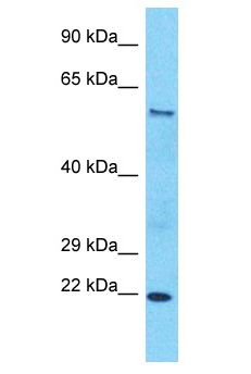 SLC43A2 Antibody - SLC43A2 antibody Western Blot of Esophagus Tumor. Antibody dilution: 1 ug/ml.  This image was taken for the unconjugated form of this product. Other forms have not been tested.