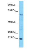 SLC43A2 Antibody - SLC43A2 antibody Western Blot of Esophagus Tumor. Antibody dilution: 1 ug/ml.  This image was taken for the unconjugated form of this product. Other forms have not been tested.
