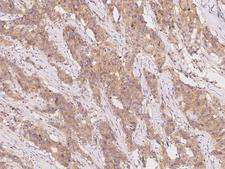 SLC44A1 / CD92 Antibody - Immunochemical staining of human SLC44A1 in human breast carcinoma with rabbit polyclonal antibody at 1:100 dilution, formalin-fixed paraffin embedded sections.