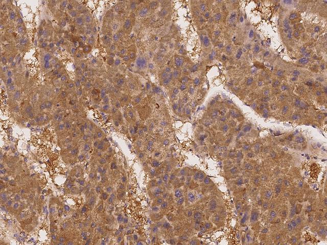 SLC44A1 / CD92 Antibody - Immunochemical staining of human SLC44A1 in human hepatoma with rabbit polyclonal antibody at 1:100 dilution, formalin-fixed paraffin embedded sections.
