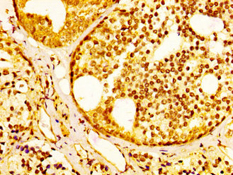SLC45A3 / Prostein / p501S Antibody - Immunohistochemistry image at a dilution of 1:300 and staining in paraffin-embedded human prostate cancer performed on a Leica BondTM system. After dewaxing and hydration, antigen retrieval was mediated by high pressure in a citrate buffer (pH 6.0) . Section was blocked with 10% normal goat serum 30min at RT. Then primary antibody (1% BSA) was incubated at 4 °C overnight. The primary is detected by a biotinylated secondary antibody and visualized using an HRP conjugated SP system.