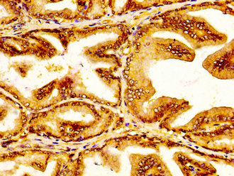 SLC45A3 / Prostein / p501S Antibody - Immunohistochemistry image at a dilution of 1:300 and staining in paraffin-embedded human prostate tissue performed on a Leica BondTM system. After dewaxing and hydration, antigen retrieval was mediated by high pressure in a citrate buffer (pH 6.0) . Section was blocked with 10% normal goat serum 30min at RT. Then primary antibody (1% BSA) was incubated at 4 °C overnight. The primary is detected by a biotinylated secondary antibody and visualized using an HRP conjugated SP system.