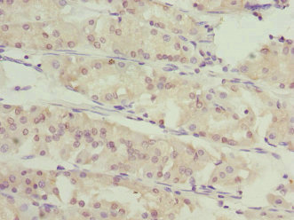 SLC46A1 / HCP1 Antibody - Immunohistochemistry of paraffin-embedded human gastric cancer at dilution 1:100