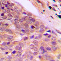 SLC4A1AP / Kanadaptin Antibody - Immunohistochemical analysis of Kanadaptin staining in human breast cancer formalin fixed paraffin embedded tissue section. The section was pre-treated using heat mediated antigen retrieval with sodium citrate buffer (pH 6.0). The section was then incubated with the antibody at room temperature and detected using an HRP conjugated compact polymer system. DAB was used as the chromogen. The section was then counterstained with hematoxylin and mounted with DPX.