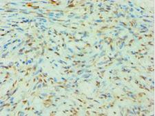 SLC4A2 / AE2 Antibody - Immunohistochemistry of paraffin-embedded human breast cancer using antibody at 1:100 dilution.