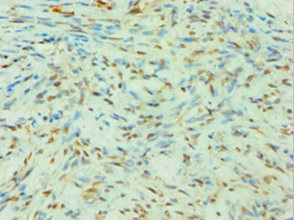 SLC4A2 / AE2 Antibody - Immunohistochemistry of paraffin-embedded human breast cancer using SLC4A2 Antibody at dilution of 1:100