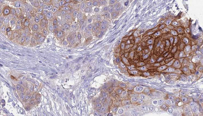 SLC4A2 / AE2 Antibody - 1:100 staining human urothelial carcinoma tissue by IHC-P. The sample was formaldehyde fixed and a heat mediated antigen retrieval step in citrate buffer was performed. The sample was then blocked and incubated with the antibody for 1.5 hours at 22°C. An HRP conjugated goat anti-rabbit antibody was used as the secondary.