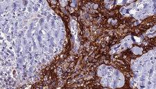 SLC4A3 / AE3 Antibody - 1:100 staining human Head and neck carcinoma tissue by IHC-P. The sample was formaldehyde fixed and a heat mediated antigen retrieval step in citrate buffer was performed. The sample was then blocked and incubated with the antibody for 1.5 hours at 22°C. An HRP conjugated goat anti-rabbit antibody was used as the secondary.