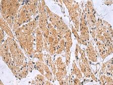 SLC4A3 / AE3 Antibody - Immunohistochemistry of paraffin-embedded Human esophagus cancer tissue  using SLC4A3 Polyclonal Antibody at dilution of 1:35(×200)