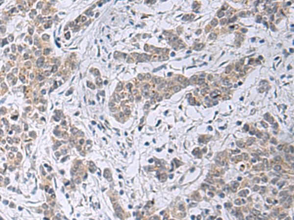 SLC4A3 / AE3 Antibody - Immunohistochemistry of paraffin-embedded Human colorectal cancer tissue  using SLC4A3 Polyclonal Antibody at dilution of 1:35(×200)