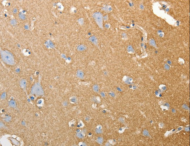SLC4A4 / NBC1 Antibody - Immunohistochemistry of paraffin-embedded Human colon cancer using SLC4A4 Polyclonal Antibody at dilution of 1:50.