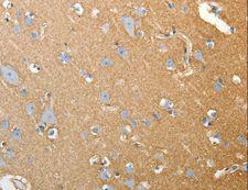 SLC4A4 / NBC1 Antibody - Immunohistochemistry of paraffin-embedded Human colon cancer using SLC4A4 Polyclonal Antibody at dilution of 1:50.