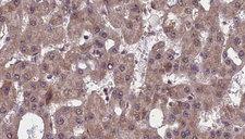 SLC4A4 / NBC1 Antibody - 1:100 staining human liver carcinoma tissues by IHC-P. The sample was formaldehyde fixed and a heat mediated antigen retrieval step in citrate buffer was performed. The sample was then blocked and incubated with the antibody for 1.5 hours at 22°C. An HRP conjugated goat anti-rabbit antibody was used as the secondary.