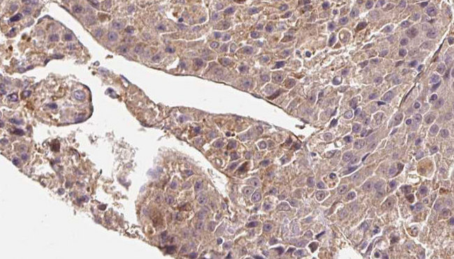 SLC4A7 Antibody - 1:100 staining human liver carcinoma tissues by IHC-P. The sample was formaldehyde fixed and a heat mediated antigen retrieval step in citrate buffer was performed. The sample was then blocked and incubated with the antibody for 1.5 hours at 22°C. An HRP conjugated goat anti-rabbit antibody was used as the secondary.