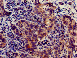 SLC4A9 / AE4 Antibody - Immunohistochemistry of paraffin-embedded human pancreatic cancer using SLC4A9 Antibody at dilution of 1:100