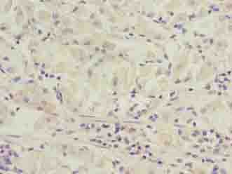 SLC52A1 / GPR172B / PAR2 Antibody - Immunohistochemistry of paraffin-embedded human gastric cancer using antibody at dilution of 1:100.