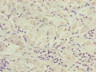 SLC52A1 / GPR172B / PAR2 Antibody - Immunohistochemistry of paraffin-embedded human gastric cancer using SLC52A1 Antibody at dilution of 1:100