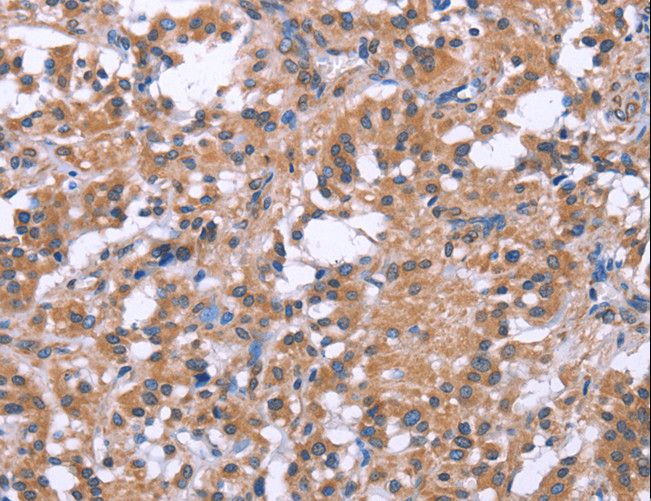 SLC52A1 / GPR172B / PAR2 Antibody - Immunohistochemistry of paraffin-embedded Human gastric cancer using SLC52A1 Polyclonal Antibody at dilution of 1:40.
