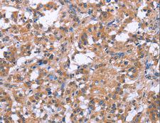 SLC52A1 / GPR172B / PAR2 Antibody - Immunohistochemistry of paraffin-embedded Human gastric cancer using SLC52A1 Polyclonal Antibody at dilution of 1:40.