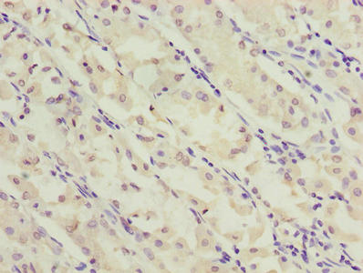 SLC52A2 / GPR172A / PAR1 Antibody - Immunohistochemistry of paraffin-embedded human gastric cancer using SLC52A2 Antibody at dilution of 1:100